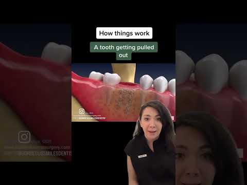 why do you need to have a bone graft done after removing a tooth⁉️