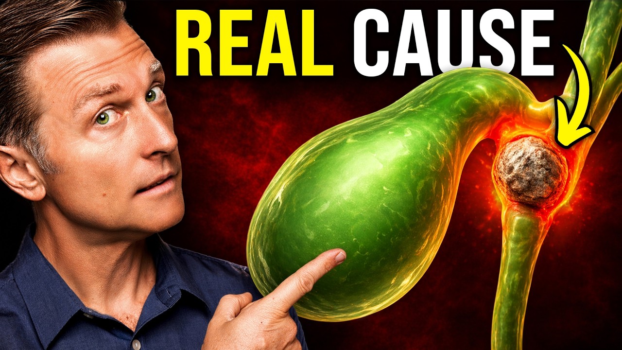 The Gallstone Mistake That Leads to SURGERY (700,000 a Year)