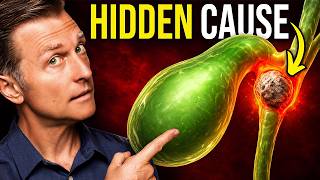 The Big Gallbladder Mistake That Leads to SURGERY (700,000 a Year)