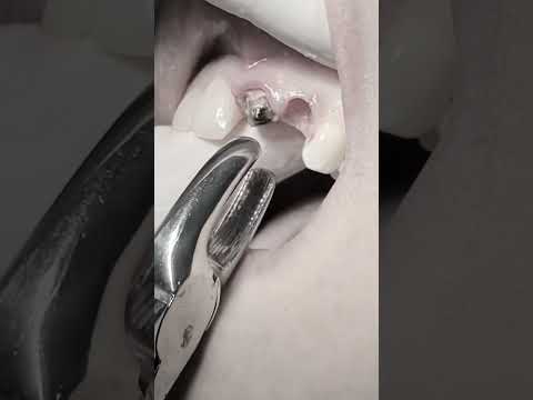 Extraction of remaining roots #dentist #dental #viralshorts