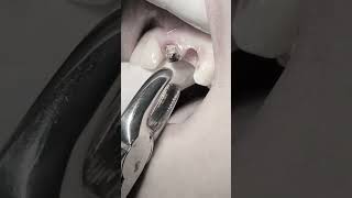 Download lagu Extraction of remaining roots #dentist #dental #viralshorts mp3