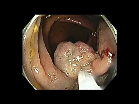 Resección mucosa endoscópica de un pólipo ubicado en un pliegue suelto del colon ascendente