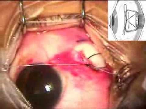 Adjustable Strabismus (Squint) Surgery: Bow-Tie technique