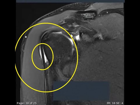 Shoulder MRI Made Easy