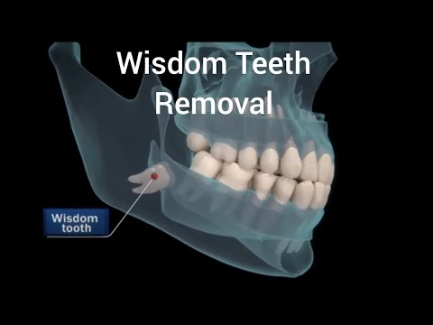 Wisdom Teeth