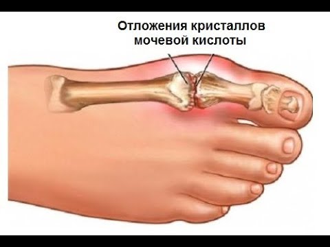 Болит спина поясница тренажерный зал Остеохондроз пояснично отдела позвоночника симптомы