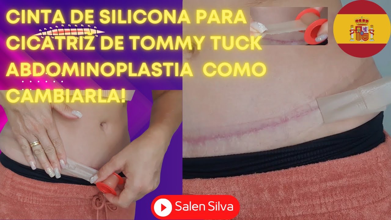 Watch Cambiar la cinta de silicona en la cicatriz de abdominoplastia o tummy tuck Now Cambiar la cinta de silicona en la cicatriz de abdominoplastia o tummy tuck