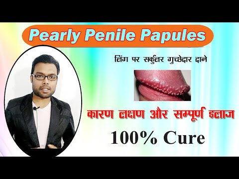 लिंग पर दाने का सम्पूर्ण समाधान | Pearly Penile papules | PPP treatment | Dr. Nitish Kumar Video