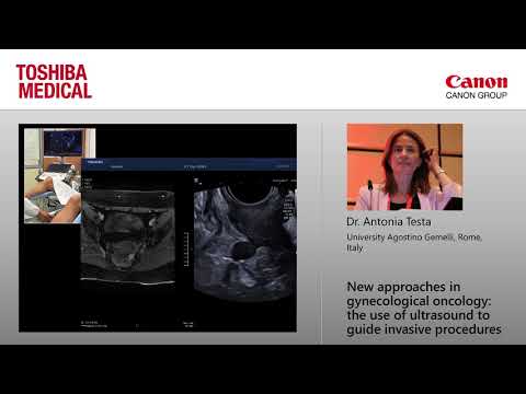Dr. Antonia Testa at ISUOG 2017 - "New approaches in gynecological oncology"