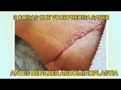 3 COISAS QUE VOCE PRECISA SABER ANTES DE FAZER ABDOMINOPLASTIA - CIRURGIA PLÁSTICA
