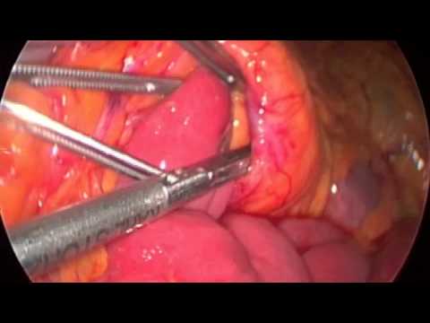 Reparación laparoscópica de una hernia paraduodenal izquierda