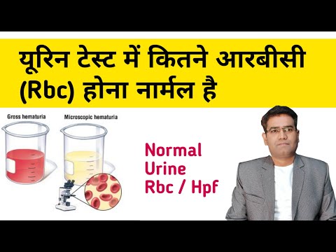 What is Normal Urine RBC/hpf - Explained | How much RBC should be in urine (HEMATURIA)