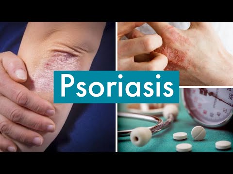 Guttate psoriasis scars