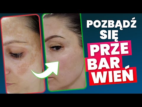 DISCOLORATIONS - How to get rid of sun spots? Skin expert Kasia's skin story!