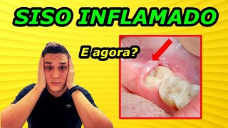 DENTE DO SISO INFLAMADO | O QUE FAZER | REMÉDIOS CASEIROS!