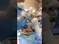 Breast Enhancement Surgery Shorts Breastimplant
