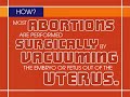 An Overview of Abortion / 2-minute version