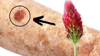 AGE SKIN SPOTS Disappear Forever if You Take This Natural Remedy