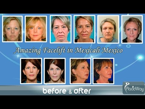 Before and After Facelift in Mexicali Mexico