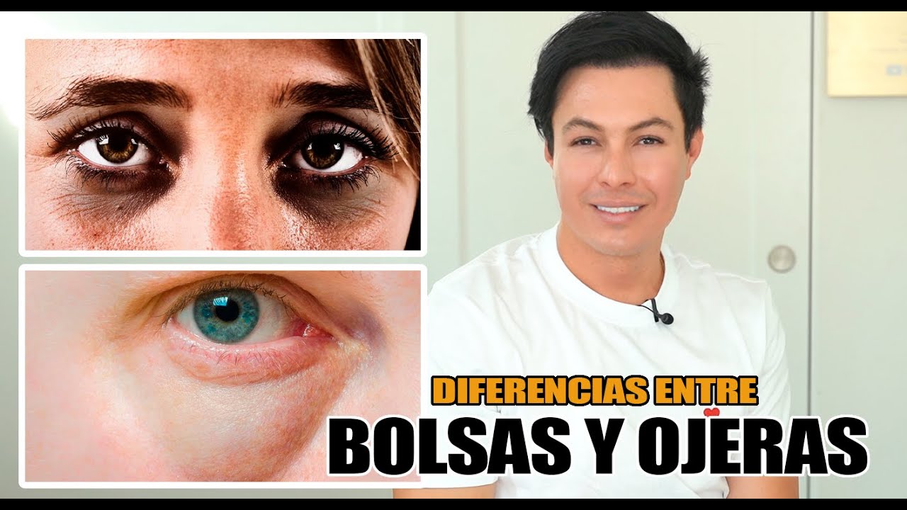 Diferencia Ente Bolsas Y Ojeras Y Como Quitarlas!