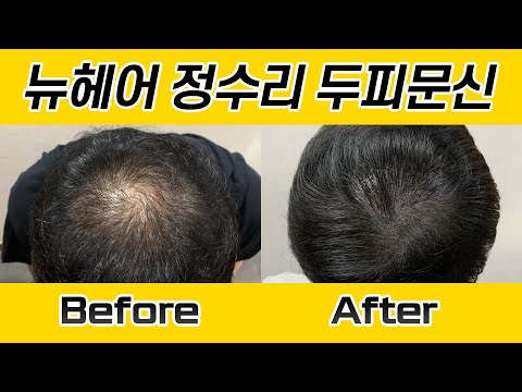 남자 정수리 두피문신 시술 전후 I 뉴헤어 SMP I 두피문신 I Before&After