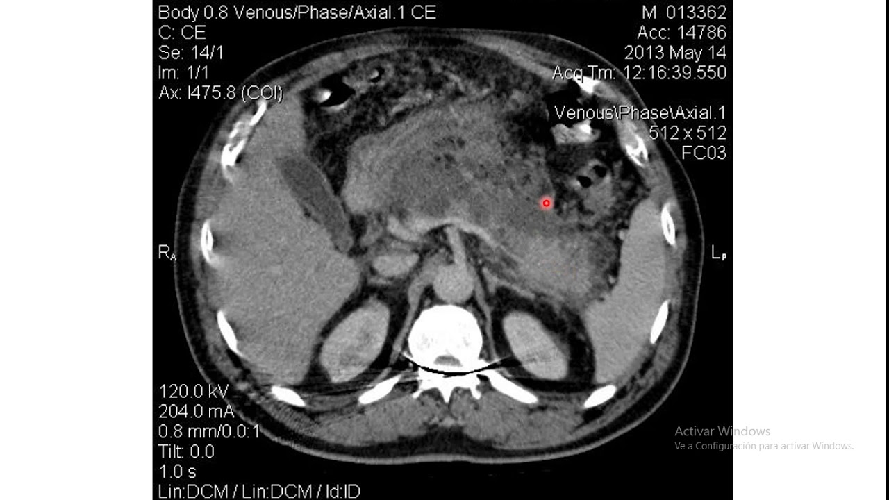 Valoración Tomografíca de Pancreatitis Aguda- Criterios de Baltazar - Dr Jorge Sibina