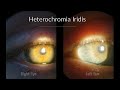 Fuchs Heterochromic Iridocyclitis -  Ophthalmology cases