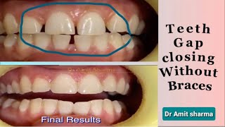 how to fix gap in front teeth without braces ? | Teeth gap filling |  gap closing in front teeth.