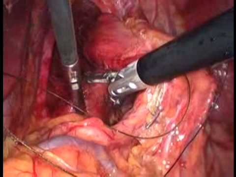 Hiatus Hernia Laparoscopic Repair 