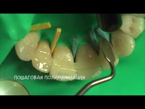 Стекловолоконное армирование композитных реставраций HD