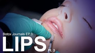 FREE LIP INJECTIONS! | Botox Journals - Ep 3 | Pt.3