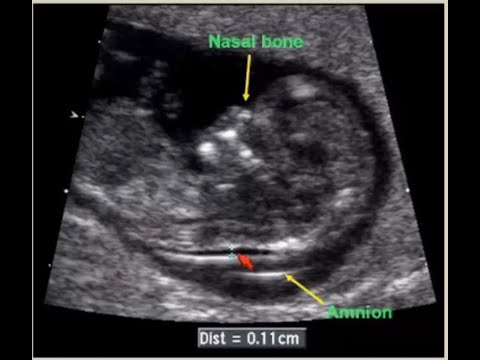 Fetal anomalies at first trimester by Ultrasound