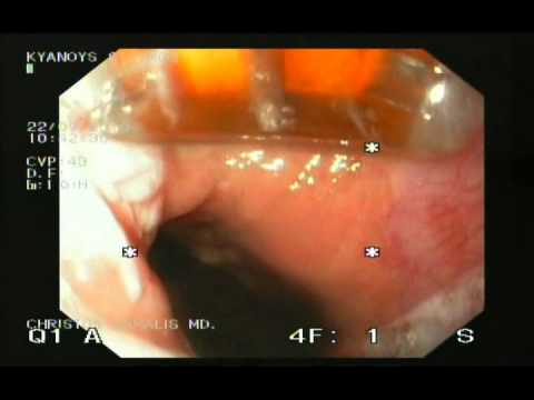 Barrett's Esophagus, No Dysplasia - Halo 90 Endoscopic Therapy