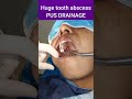HUGE dental abscess drainage😱 #shorts #dentalshorts