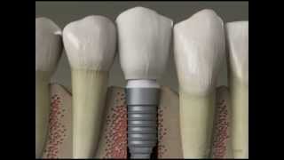 preview picture of video 'Dental Implants in Columbia and Jefferson City, Missouri at Cherry Hill Dental'