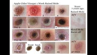 1 Month Apple Cider Vinegar vs Raised Mole