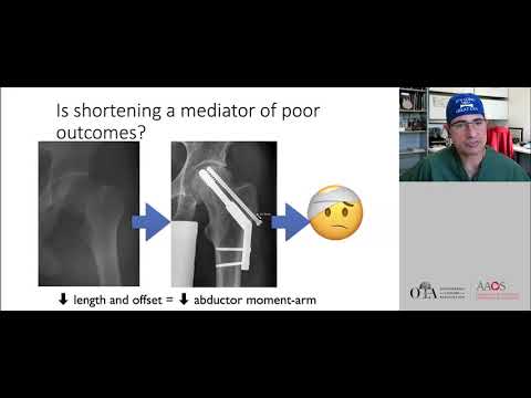 Young Femoral Neck Fracture  - Dr. Morshed