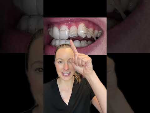 What should you do if your Invisalign trays aren’t fitting and teeth aren’t tracking?