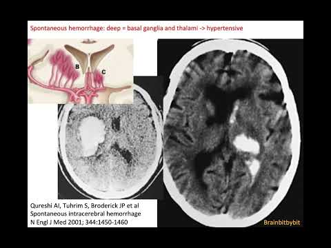 72. Hemorrhagic stroke; hypertensive haemorrhage, lobar haemorrhage, swirl, black hole, spot sign