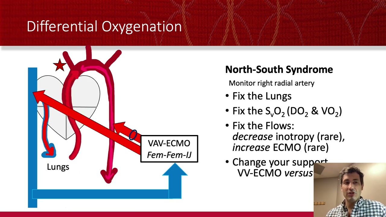 ECMO: VA ECMO For Dummies!
