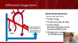 ECMO: VA ECMO For Dummies!
