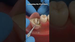 Download lagu How an Impacted Wisdom Tooth Is Removed  | 3D Simulation #dentist mp3