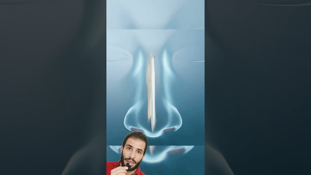 👃➡️¿Tienes. tabique nasal desviado Te interesa está cirugía ✅(SEPTOPLASTIA)