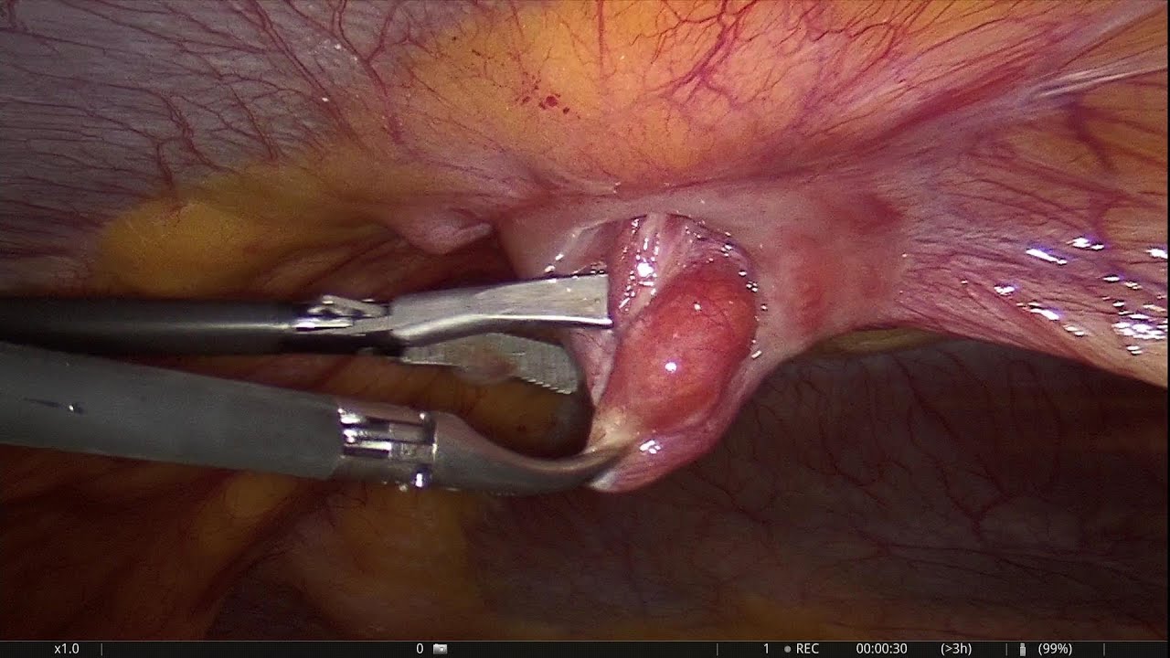 IPOM Epigastric Hernia