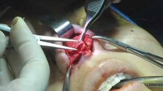How Nose Surgery is Performed – Vestibular Tissue Release (Rhinoplasty)