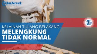Skoliosis, Penyakit Kelainan Tulang dengan Kondisi Tulang Belakang Melengkung secara Tidak Normal