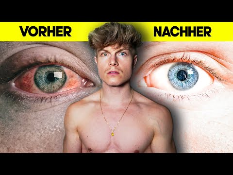 NIE WIEDER ROTE AUGEN: In 14 Tagen zu strahlend weißen Augen!