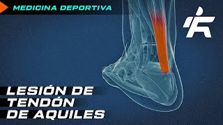 RECUPERACIÓN DE TENDÓN DE AQUILES 2021 #somosrunfit