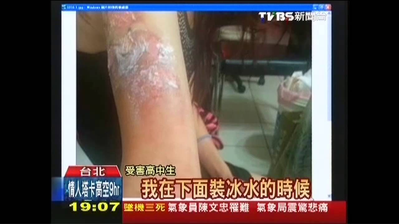 荳蔻少女打工燙半身疤! 竟求償無門