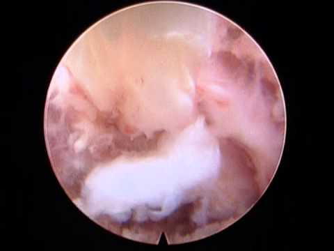 Morgengymnastik in Osteochondrose der Brust Schmerzen und zwischen den Beinen während der Schwangerschaft